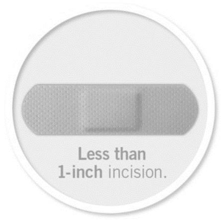  LESS THAN 1-INCH INCISION